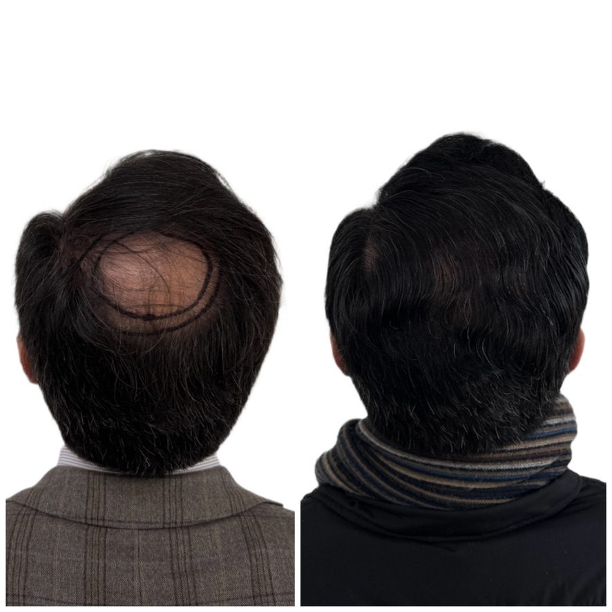 Testimonio paciente Capilux